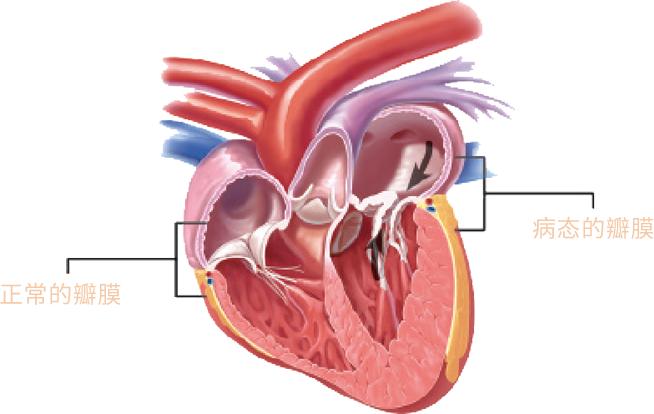认识常见的心脏病 二尖瓣疾病